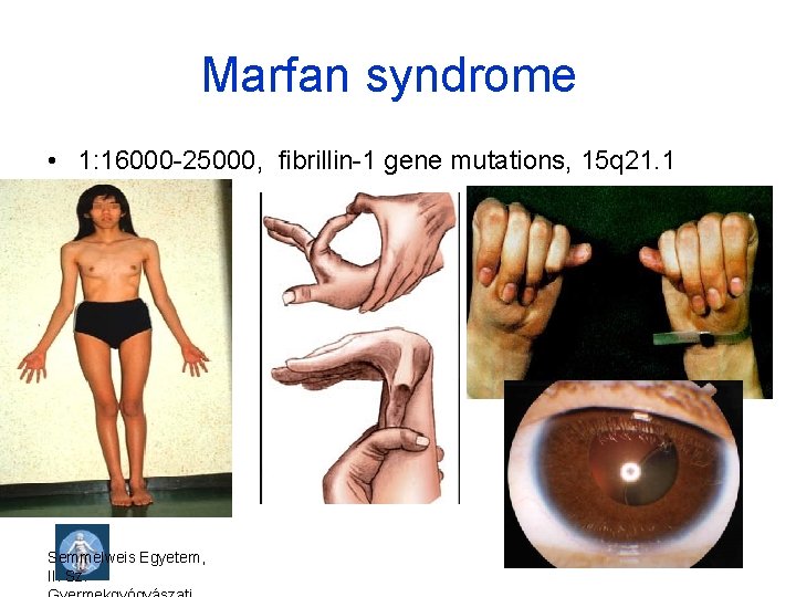 Marfan syndrome • 1: 16000 -25000, fibrillin-1 gene mutations, 15 q 21. 1 Semmelweis