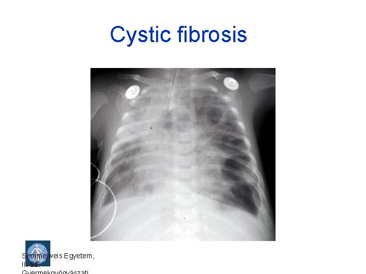 Cystic fibrosis Semmelweis Egyetem, II. Sz. 