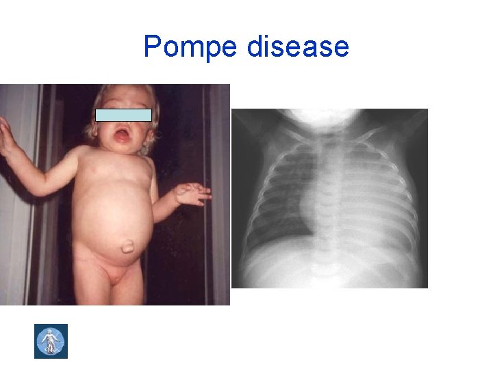 Pompe disease 