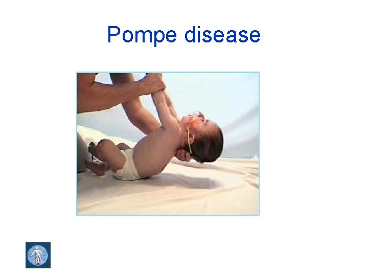 Pompe disease 