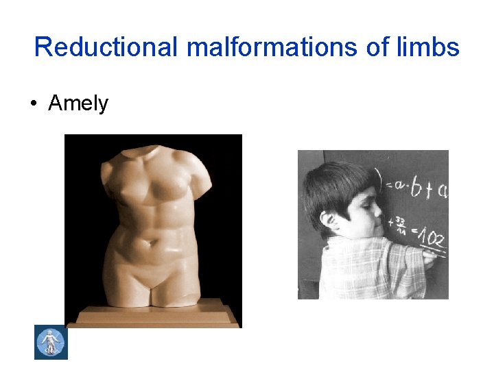 Reductional malformations of limbs • Amely 