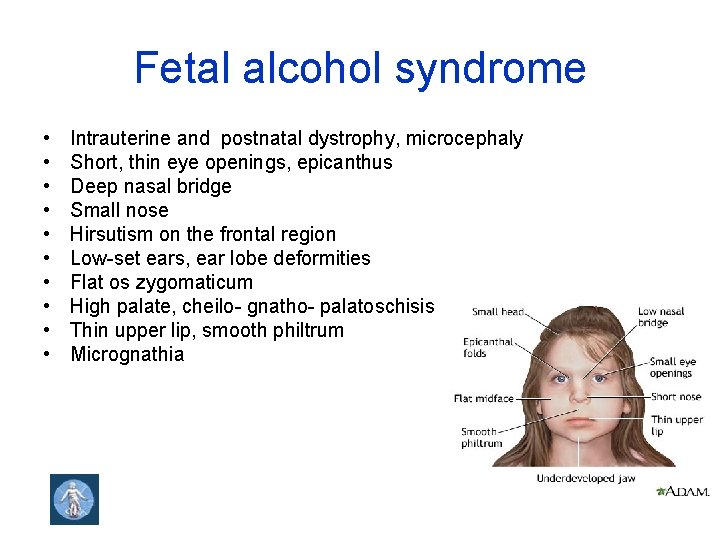 Fetal alcohol syndrome • • • Intrauterine and postnatal dystrophy, microcephaly Short, thin eye