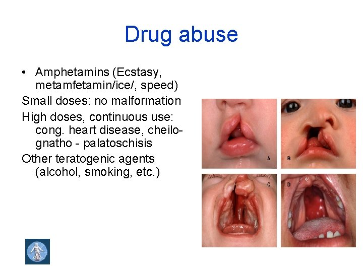 Drug abuse • Amphetamins (Ecstasy, metamfetamin/ice/, speed) Small doses: no malformation High doses, continuous