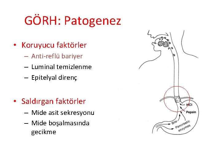 GÖRH: Patogenez • Koruyucu faktörler – Anti-reflü bariyer – Luminal temizlenme – Epitelyal direnç