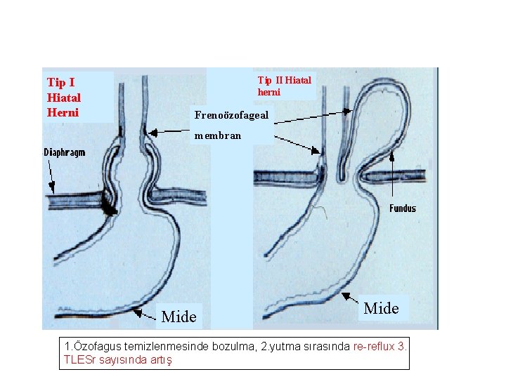 Tip I Hiatal Herni Tip II Hiatal herni Frenoözofageal membran Mide 1. Özofagus temizlenmesinde