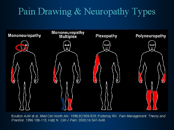 Pain Drawing & Neuropathy Types Boulton AJM et al. Med Clin North Am. 1998;