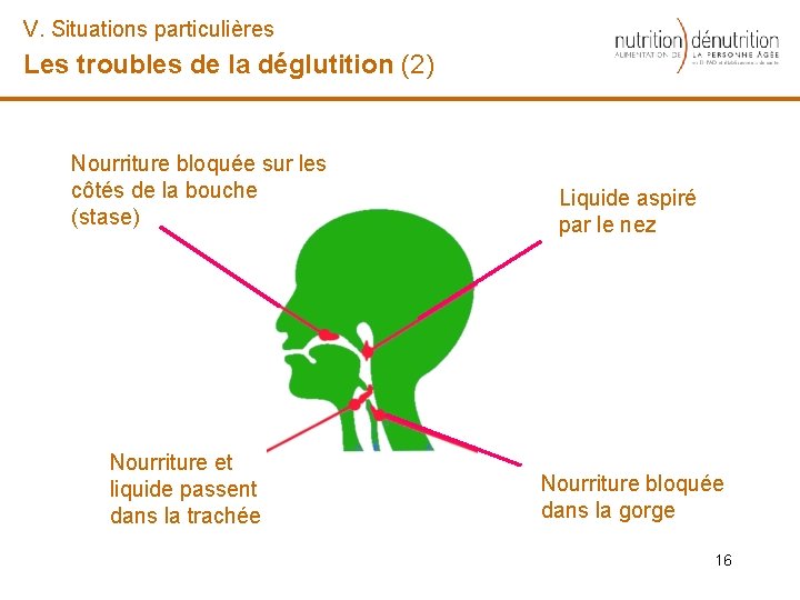 V. Situations particulières Les troubles de la déglutition (2) Nourriture bloquée sur les côtés