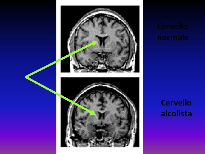 Cervello normale Cervello alcolista 