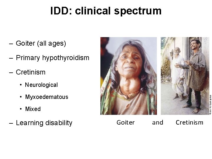 IDD: clinical spectrum – Goiter (all ages) – Primary hypothyroidism – Cretinism • Neurological
