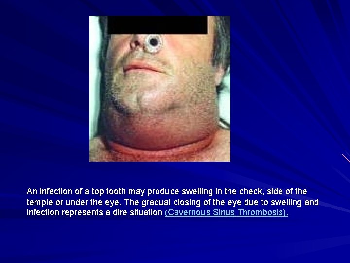 An infection of a top tooth may produce swelling in the check, side of An infection of a top tooth may produce swelling in the check, side of