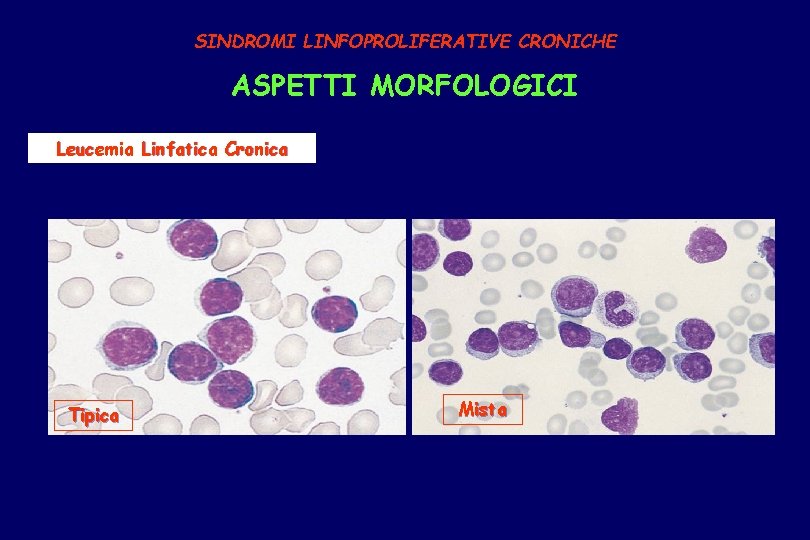 SINDROMI LINFOPROLIFERATIVE CRONICHE ASPETTI MORFOLOGICI Leucemia Linfatica Cronica Tipica Mista 