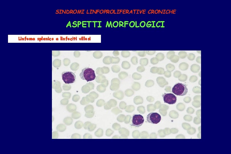 SINDROMI LINFOPROLIFERATIVE CRONICHE ASPETTI MORFOLOGICI Linfoma splenico a linfociti villosi 