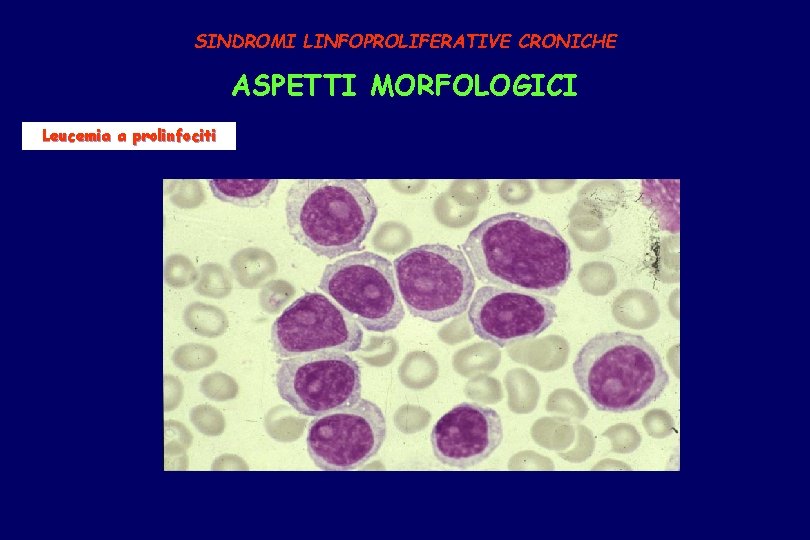 SINDROMI LINFOPROLIFERATIVE CRONICHE ASPETTI MORFOLOGICI Leucemia a prolinfociti 