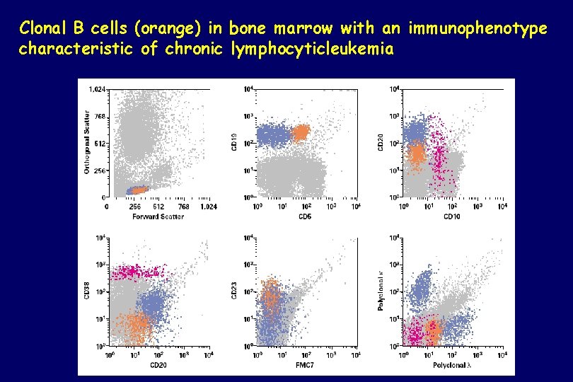 Clonal B cells (orange) in bone marrow with an immunophenotype characteristic of chronic lymphocyticleukemia