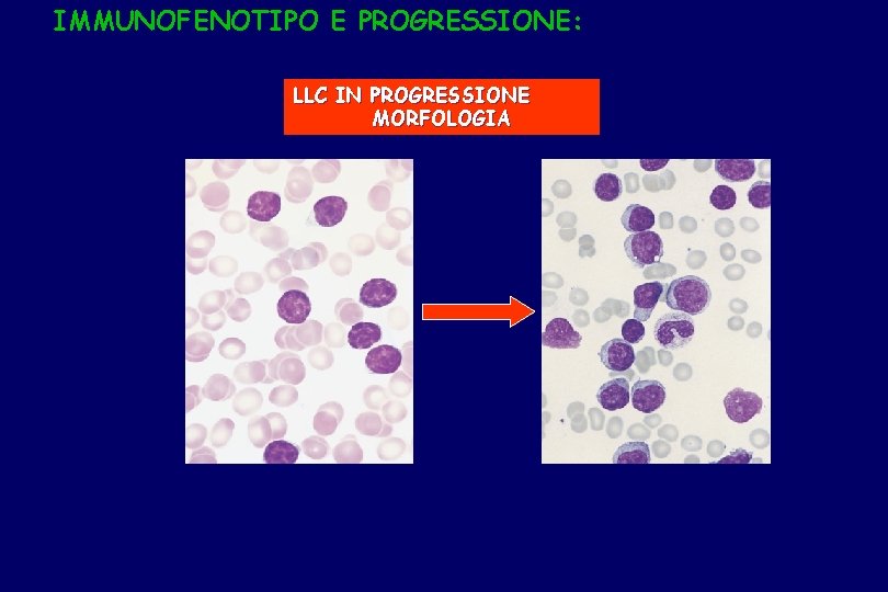 IMMUNOFENOTIPO E PROGRESSIONE: LLC IN PROGRESSIONE MORFOLOGIA 