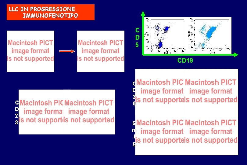 LLC IN PROGRESSIONE IMMUNOFENOTIPO C D 5 CD 19 C D 2 3 C