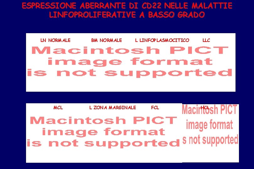 ESPRESSIONE ABERRANTE DI CD 22 NELLE MALATTIE LINFOPROLIFERATIVE A BASSO GRADO LN NORMALE MCL