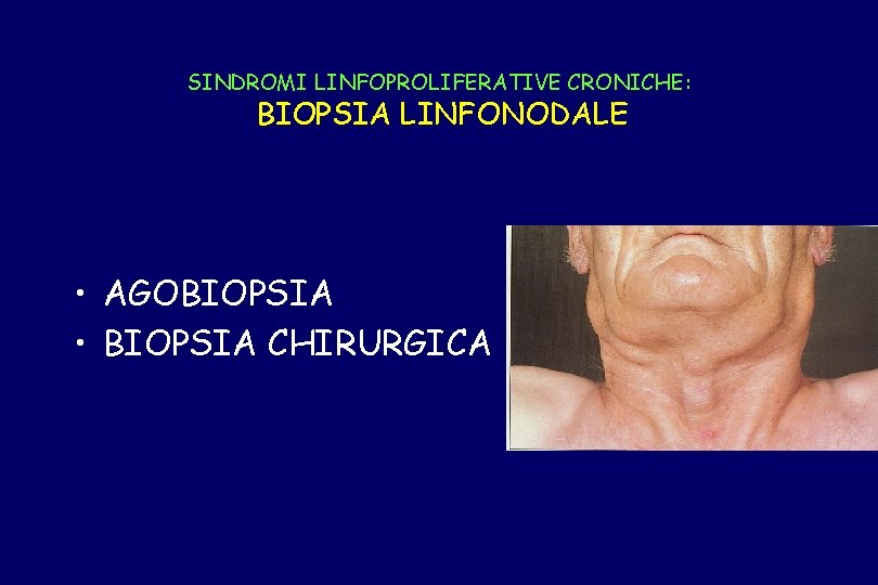 SINDROMI LINFOPROLIFERATIVE CRONICHE: BIOPSIA LINFONODALE • AGOBIOPSIA • BIOPSIA CHIRURGICA 