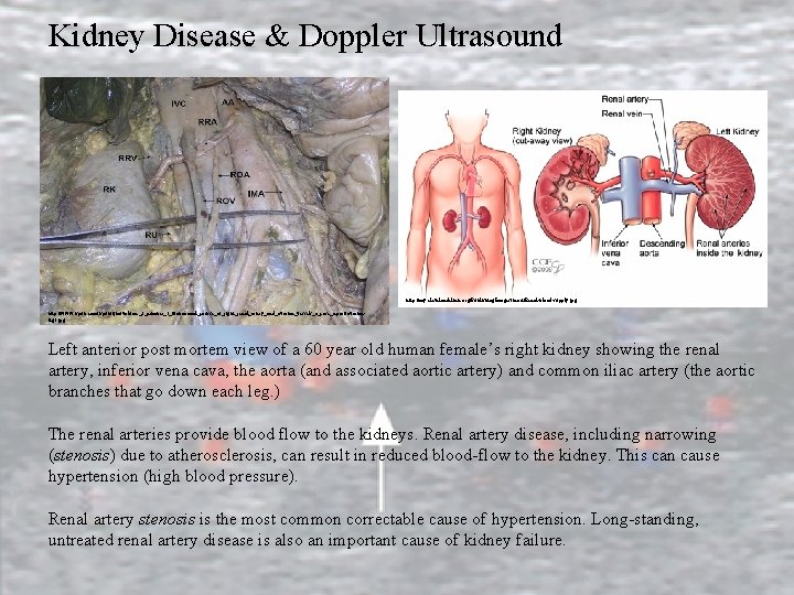 Kidney Disease & Doppler Ultrasound http: //my. clevelandclinic. org/Publishing. Images/heart/Renal-blood-supply. jpg http: //www. ispub.