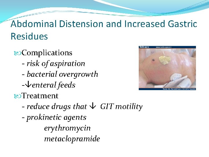 Abdominal Distension and Increased Gastric Residues Complications - risk of aspiration - bacterial overgrowth