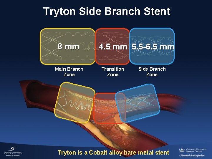 Tryton Side Branch Stent 8 mm Main Branch Zone 4. 5 mm 5. 5