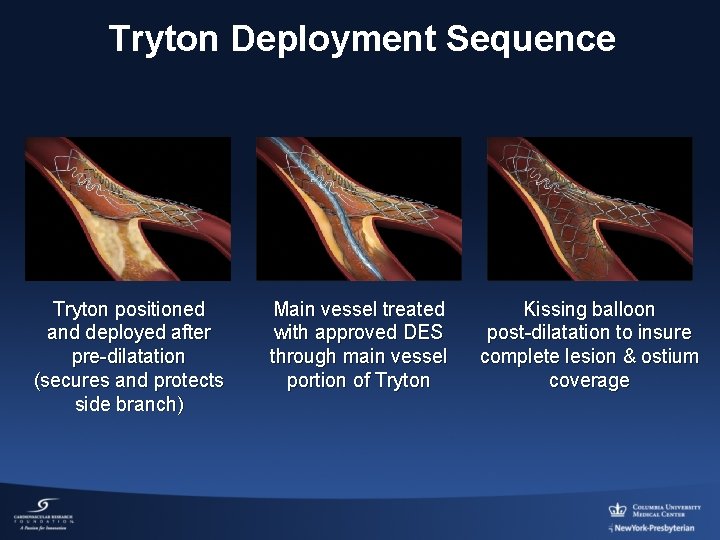 Tryton Deployment Sequence Tryton positioned and deployed after pre-dilatation (secures and protects side branch)