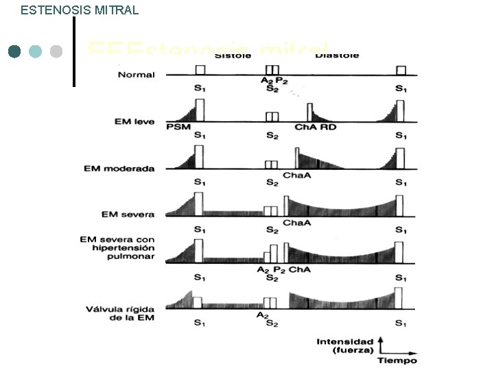 ESTENOSIS MITRAL EEEstenosis mitral 