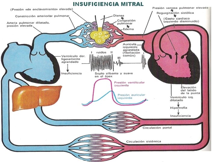 INSUFICIENCIA MITRAL 
