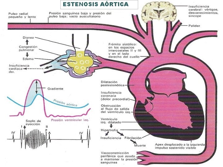 ESTENOSIS AÓRTICA 