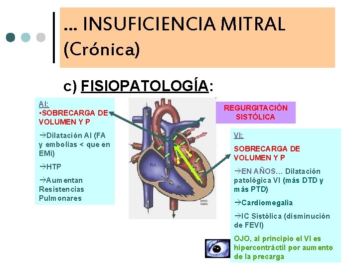 … INSUFICIENCIA MITRAL (Crónica) c) FISIOPATOLOGÍA: AI: • SOBRECARGA DE VOLUMEN Y P Dilatación