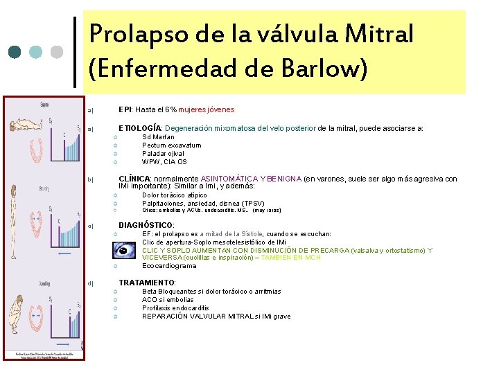 Prolapso de la válvula Mitral (Enfermedad de Barlow) EPI: Hasta el 6% mujeres jóvenes