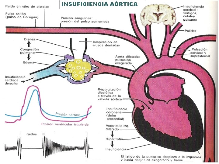 INSUFICIENCIA AÓRTICA 