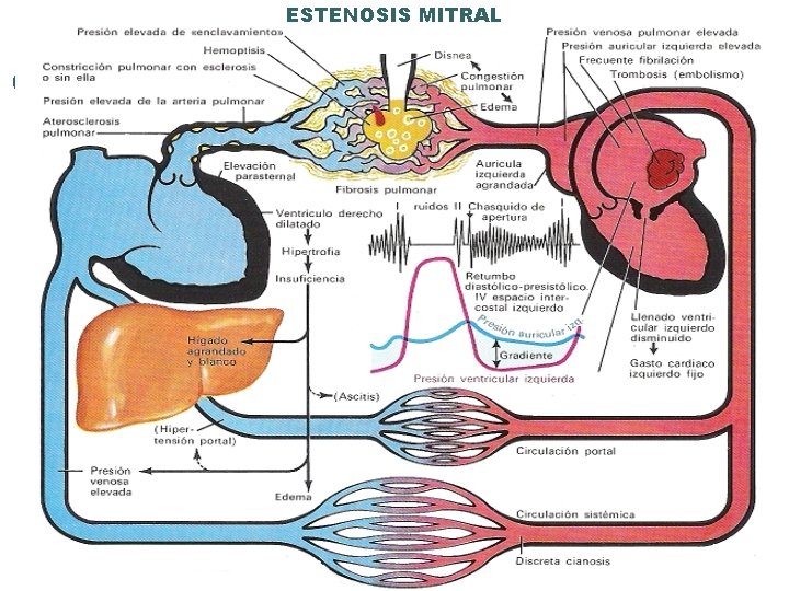 ESTENOSIS MITRAL 