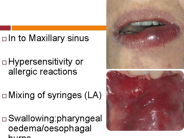  In to Maxillary sinus Hypersensitivity or allergic reactions Mixing of syringes (LA) Swallowing: