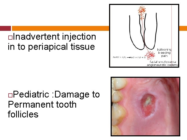 Inadvertent injection in to periapical tissue Pediatric : Damage to Permanent tooth follicles 