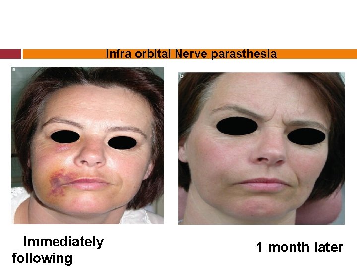 Infra orbital Nerve parasthesia Immediately following 1 month later 