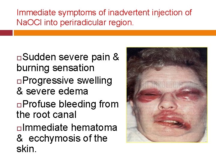 Immediate symptoms of inadvertent injection of Na. OCl into periradicular region. Sudden severe pain