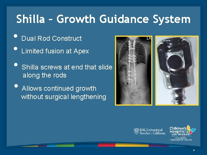 Shilla – Growth Guidance System • Dual Rod Construct • Limited fusion at Apex