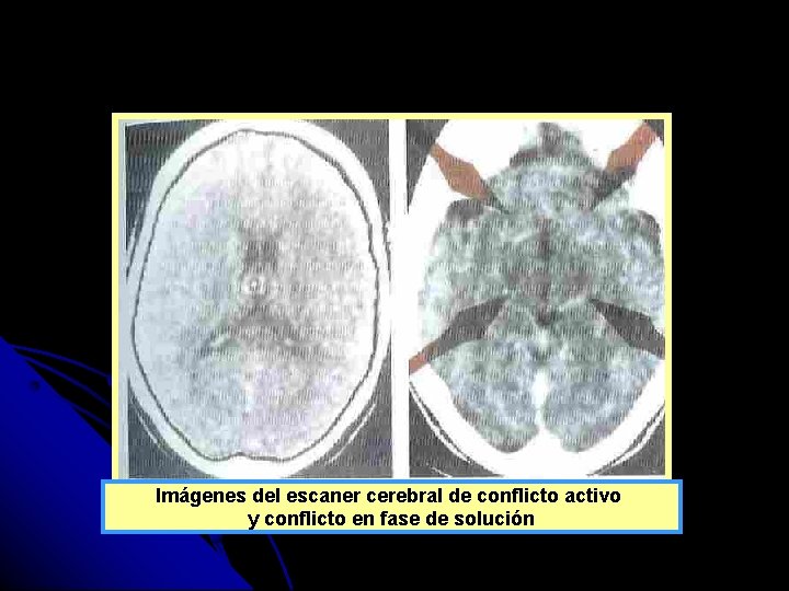 Imágenes del escaner cerebral de conflicto activo y conflicto en fase de solución 