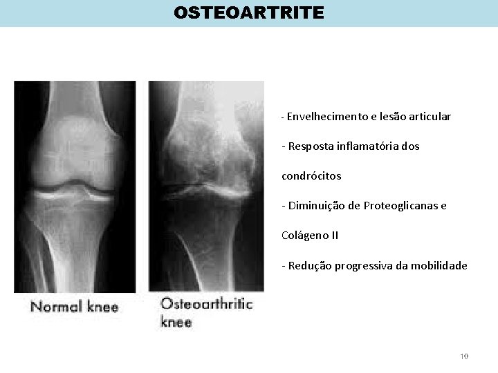 OSTEOARTRITE - Envelhecimento e lesão articular - Resposta inflamatória dos condrócitos - Diminuição de