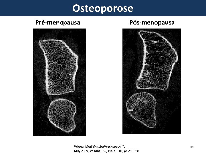 Osteoporose Pré-menopausa Pós-menopausa Wiener Medizinische Wochenschrift May 2009, Volume 159, Issue 9 -10, pp