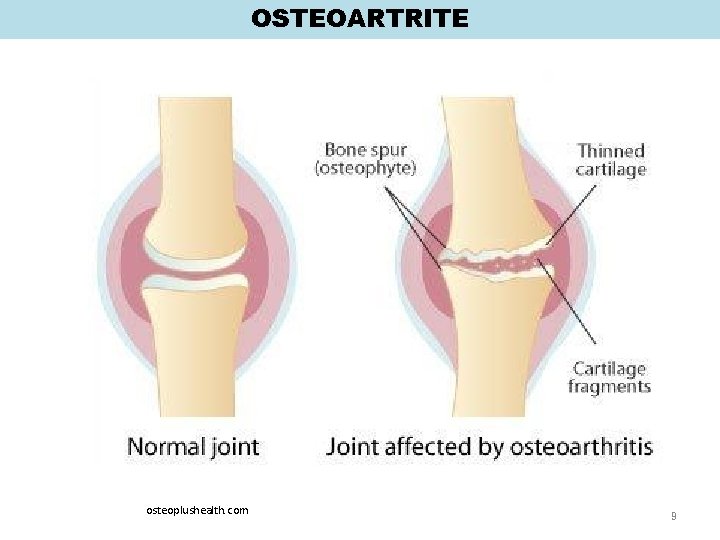 OSTEOARTRITE osteoplushealth. com 9 