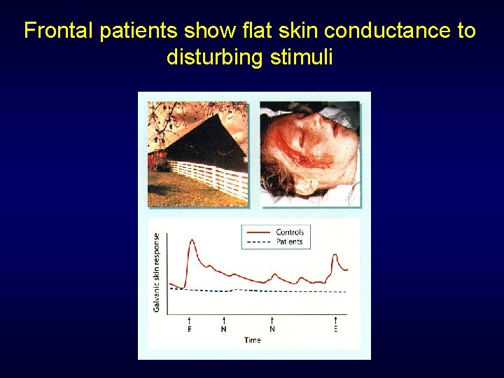 Frontal patients show flat skin conductance to disturbing stimuli 