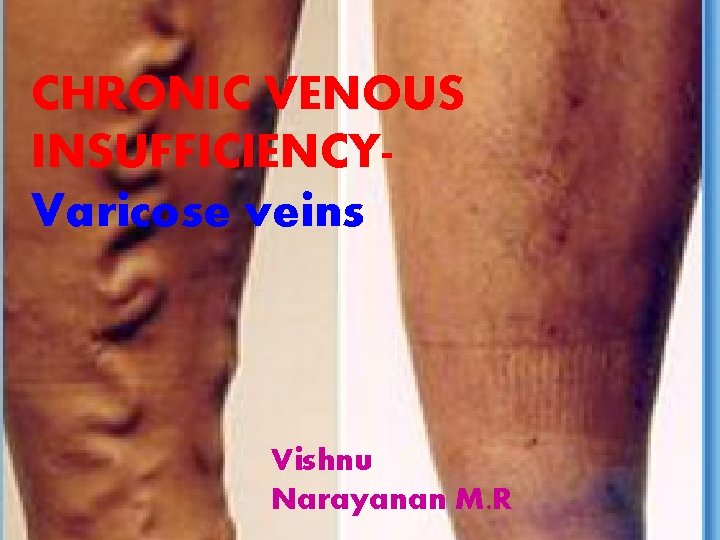 CHRONIC VENOUS INSUFFICIENCYVaricose veins Vishnu Narayanan M. R 
