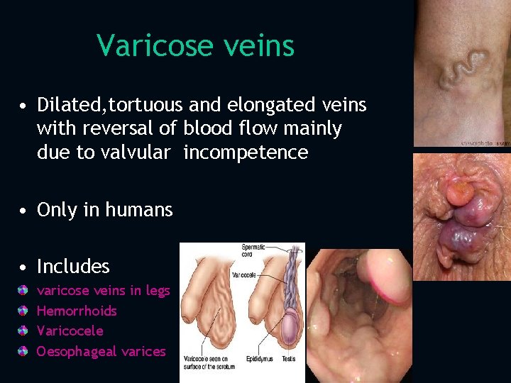 Varicose veins • Dilated, tortuous and elongated veins with reversal of blood flow mainly