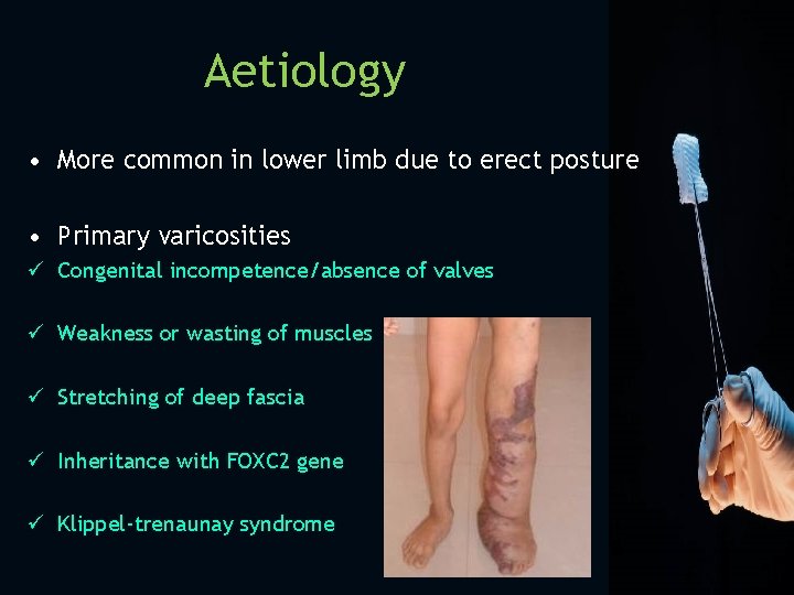 Aetiology • More common in lower limb due to erect posture • Primary varicosities