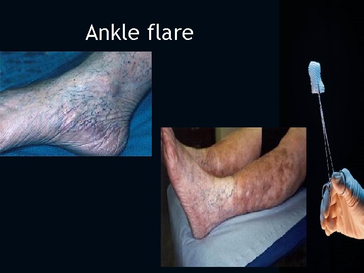 Ankle flare 