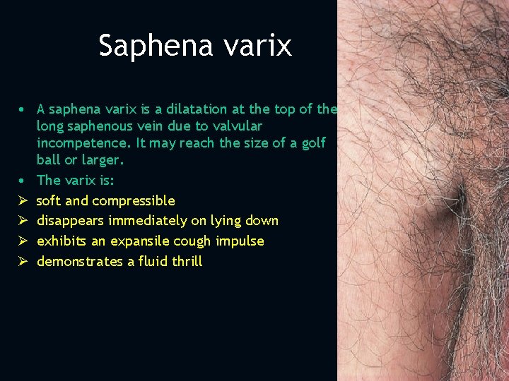 Saphena varix • A saphena varix is a dilatation at the top of the