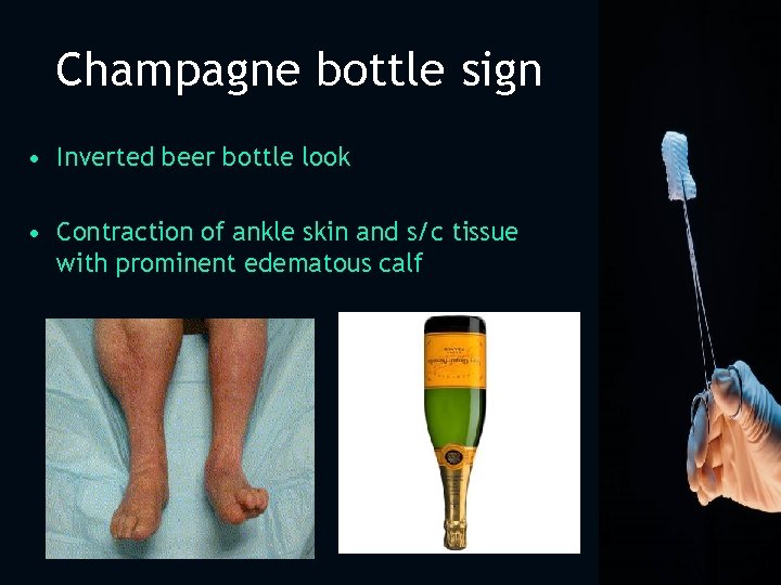 Champagne bottle sign • Inverted beer bottle look • Contraction of ankle skin and