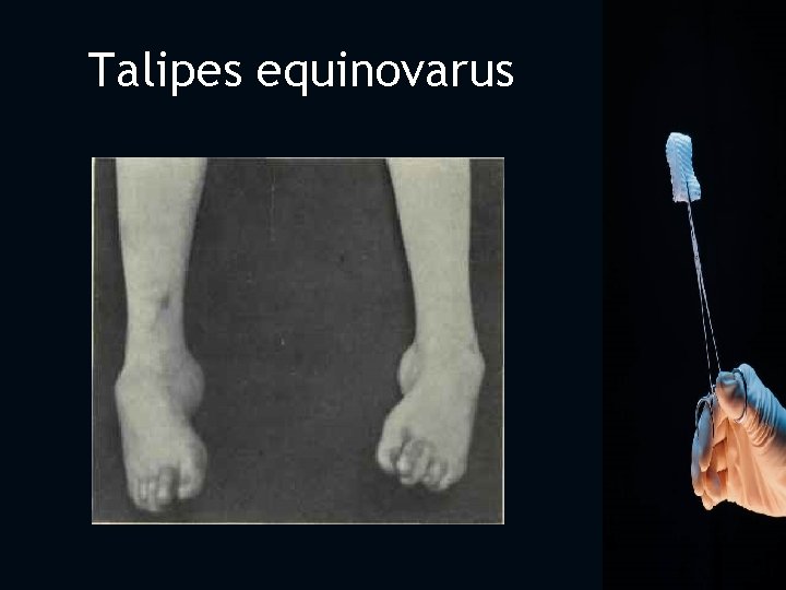 Talipes equinovarus 